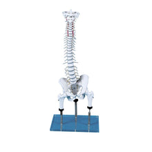 Anatomisches Modell von Wirbelsäule, Becken und Oberschenkeln mit markierter Fehlstellung