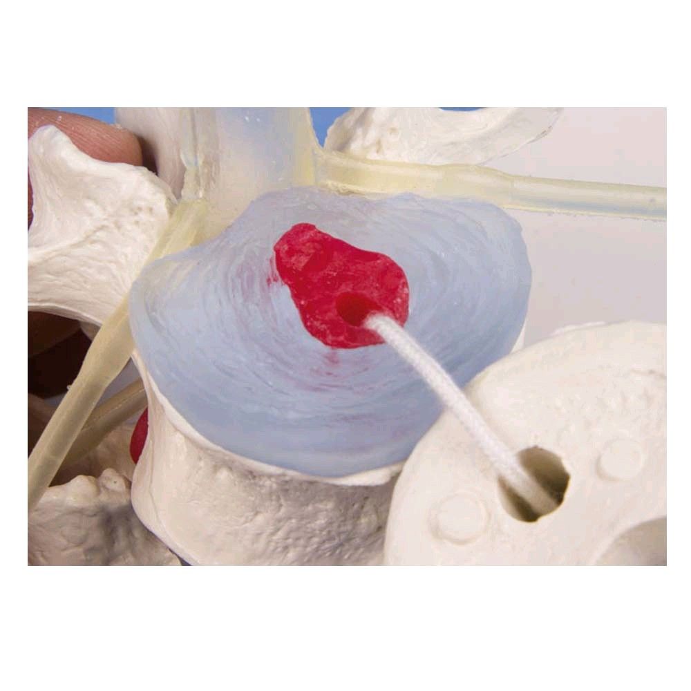 Nahansicht Lendenwirbelmodell: rote Bandscheibenwölbung im blauen Ring