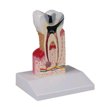 Zahnkariesmodell Erler Zimmer, unterer Molar, Schnittmodell auf Sockel