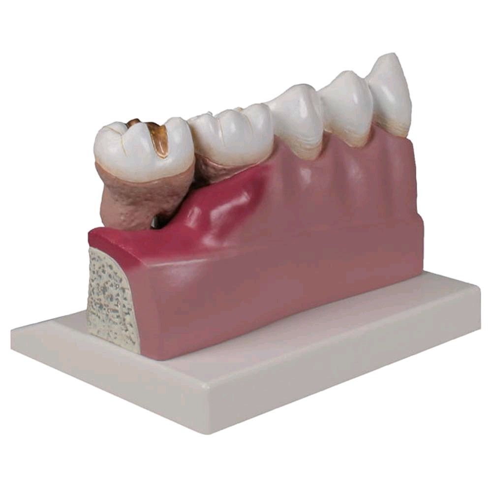 Dentalmodell Unterkieferzähne 3–7 auf farbiger Modellplatte