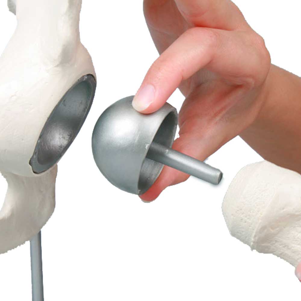 Detailansicht: Hand hält Schalenprothese mit Metallstiel am Hüftmodell