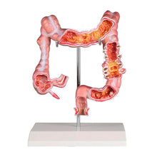 Erler Zimmer Modell Dickdarm mit Erkrankungen, anatomisches Transparentmodell auf Ständer
