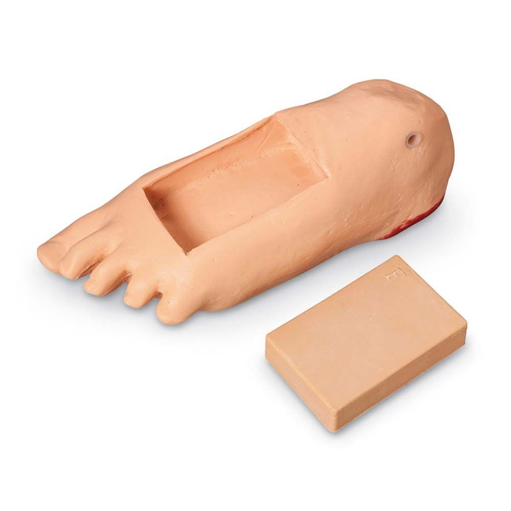 Puppen-Fuß mit Ödem und Gewebeveränderung, plus beige Auflage-Block