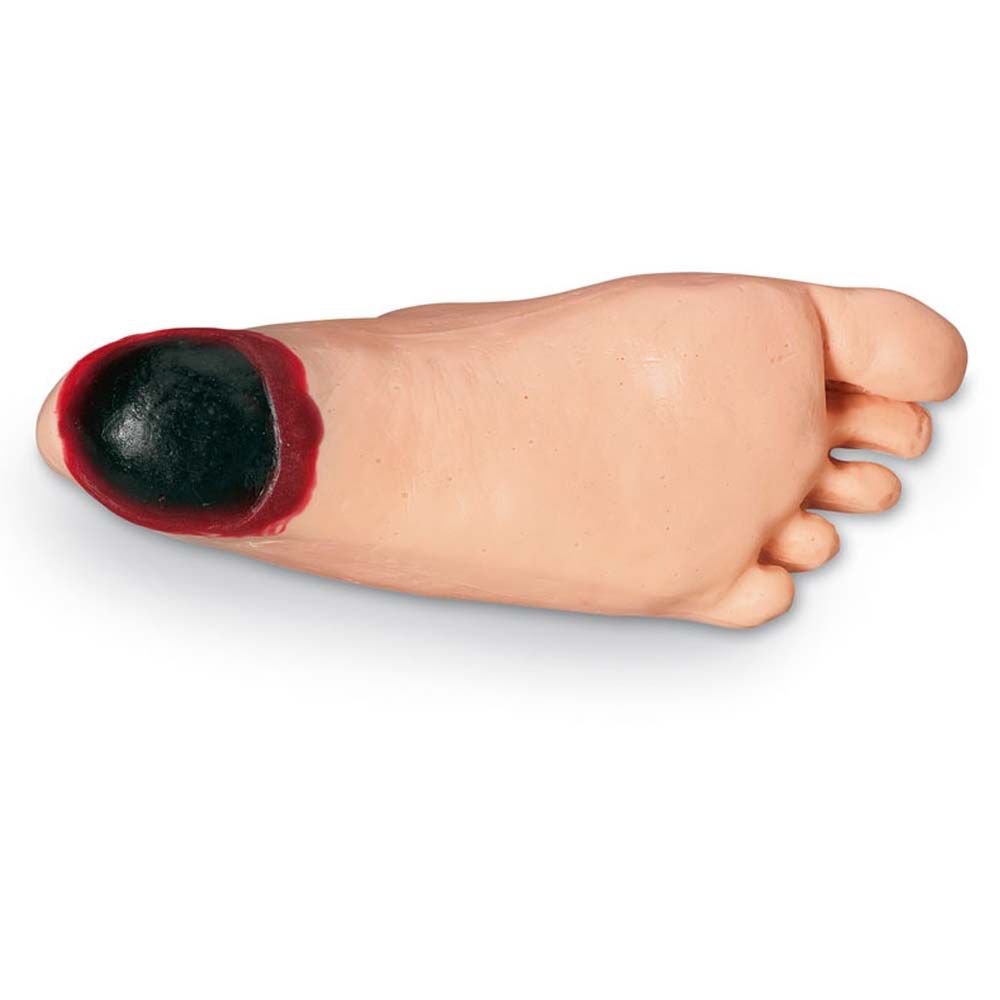 Puppen-Fußsohle mit tiefer Nekrose-Stelle, dunkelrote und schwarze Wundfläche