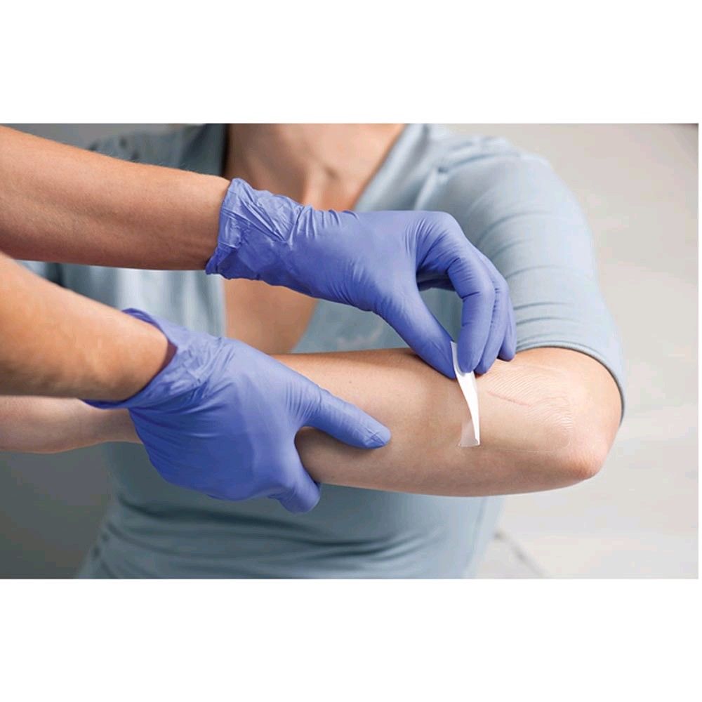 Transparentverband Hydrofilm auf dem Unterarm, Aufbringen durch medizinisches Personal mit Handschuhen